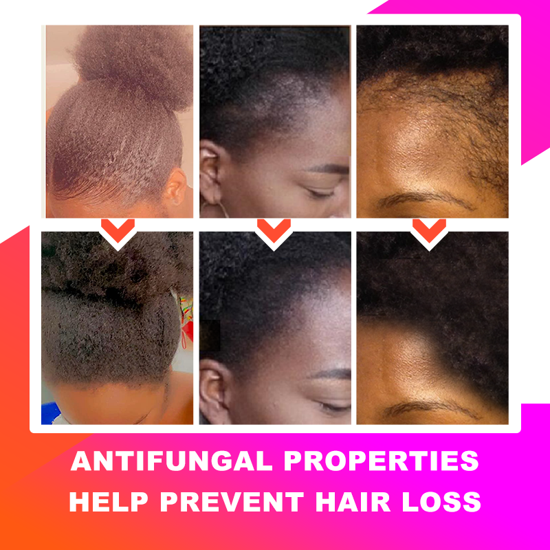 Sevich Hair Growth Products for Women Africa Traction Alopecia Chebe Hair Growing Oil Anti Hair Loss Rswank
